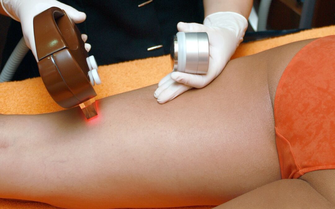 Épilation laser : le déroulement de la première séance